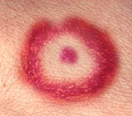 A sign of Lyme Disease is the bullseye mark on the skin. Photo/American Lyme Disease Foundation